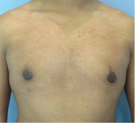 Gynecomastia Surgery Before and After Case 9