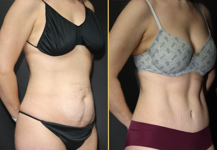Before and after abdominal contouring comparison showing reduced midsection fullness