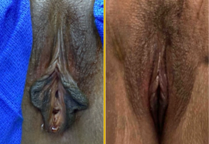 Case 819 before and after labiaplasty with yellow divider line