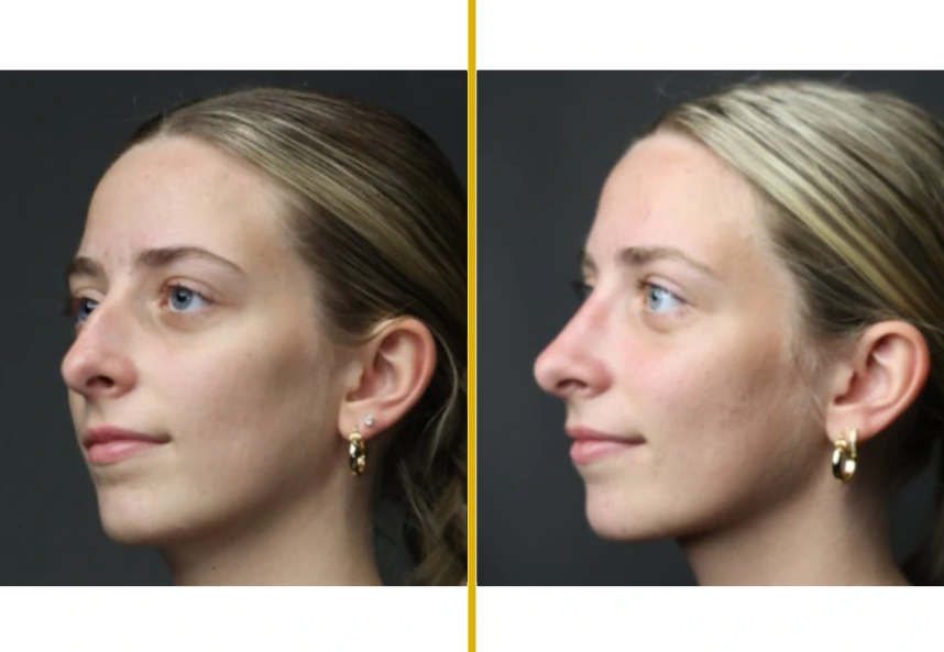 Before and after side profile comparison of a woman's face following cosmetic treatment