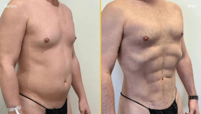 BeforeAfter 2