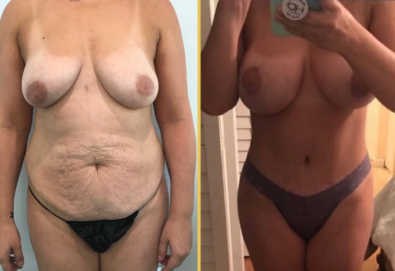 Tummy tuck main
