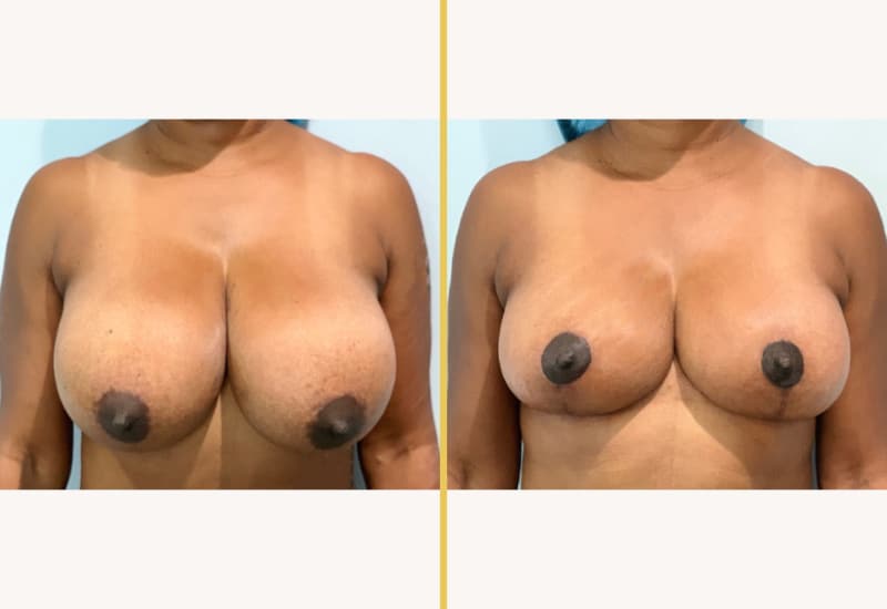 breast red main