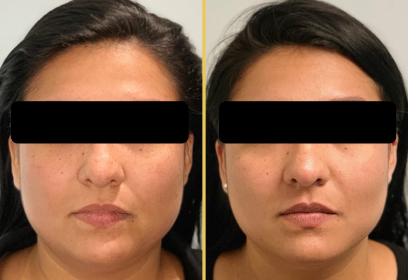 buccal fat 188 main