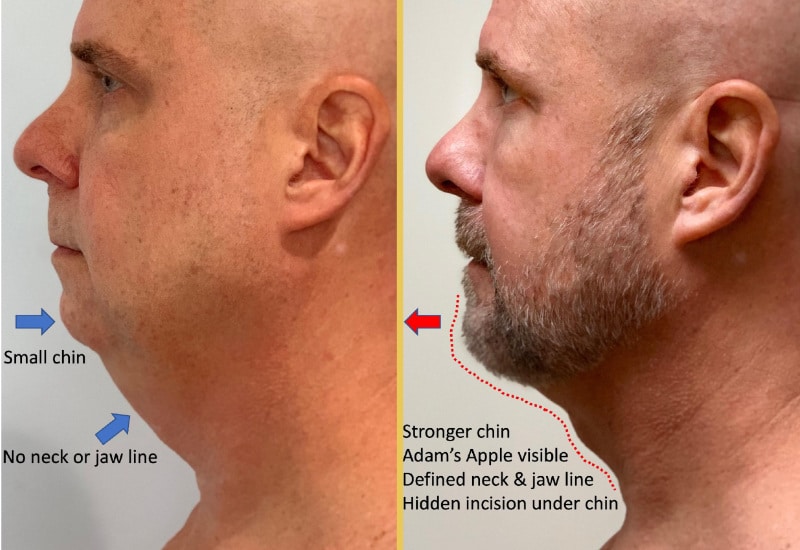 chin implant