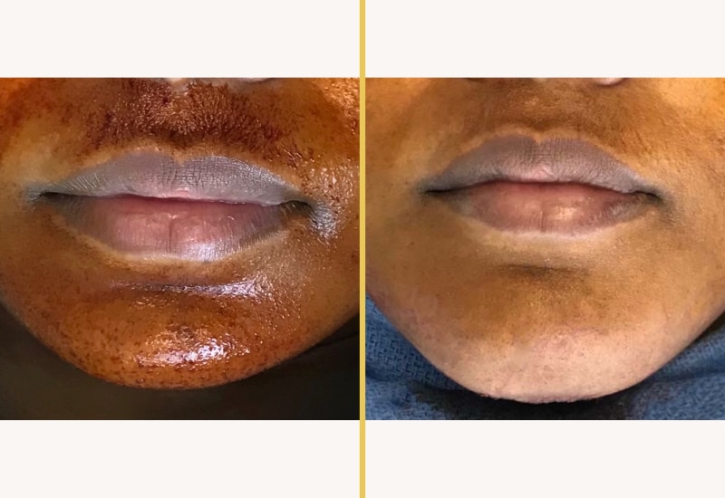 chin implant18 main