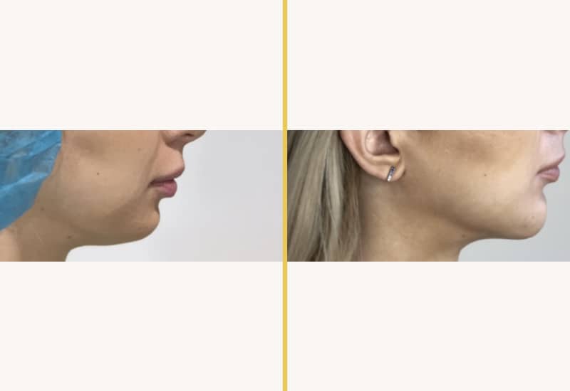 chin implant 21 main