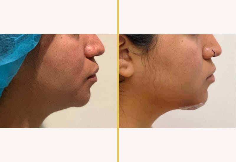 chin implant 280 m