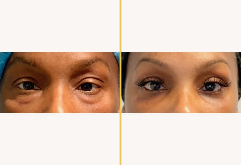 eyelid 468 main