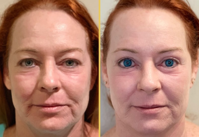 eyelid surgery 292