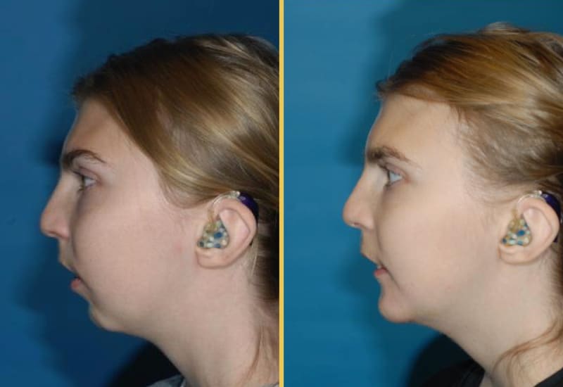 genioplasty 22 main