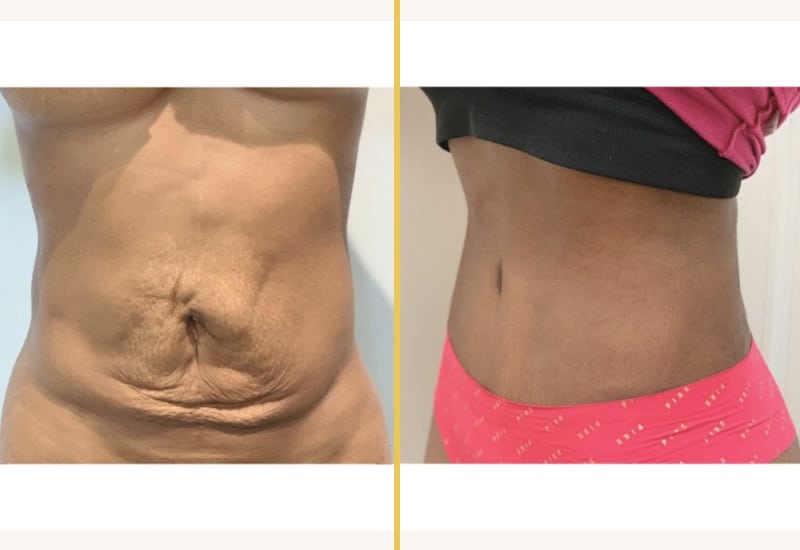 ab silh with tummy 1