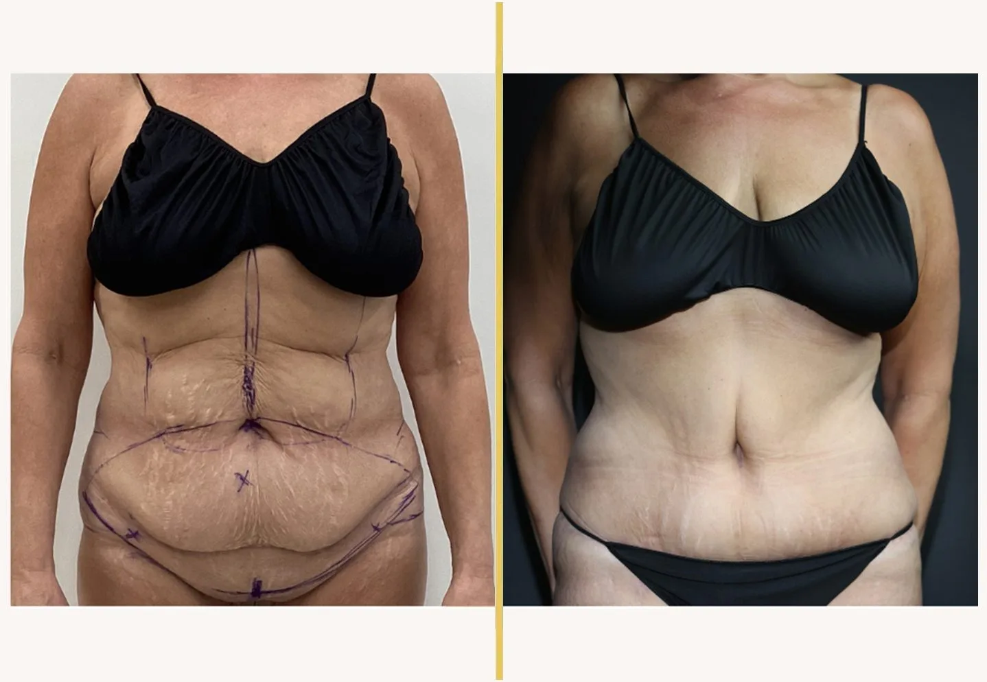 Before and after front view of abdominoplasty with marked improvement in abdominal contour