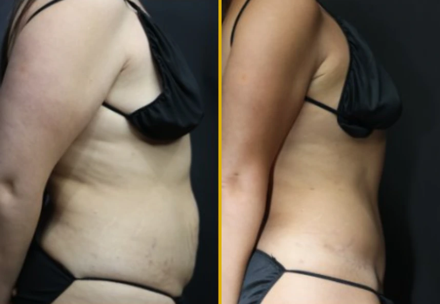 Before and after liposuction results showing abdominal contouring improvement