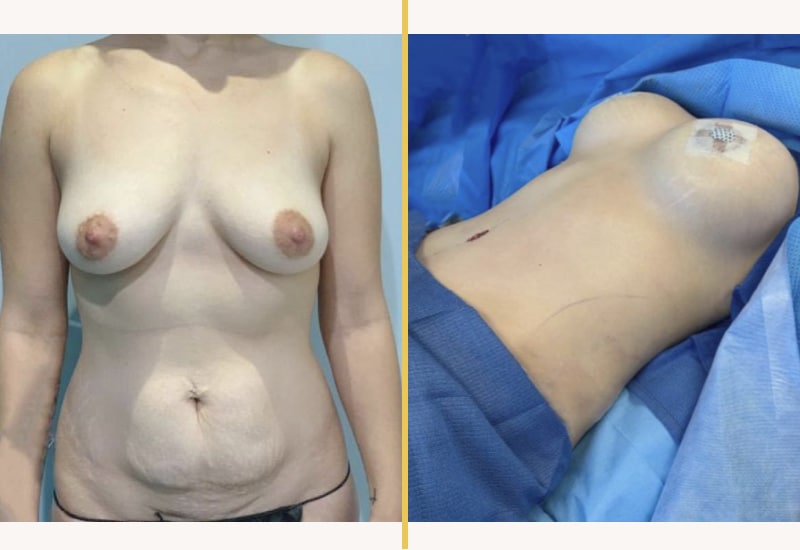 case 215
