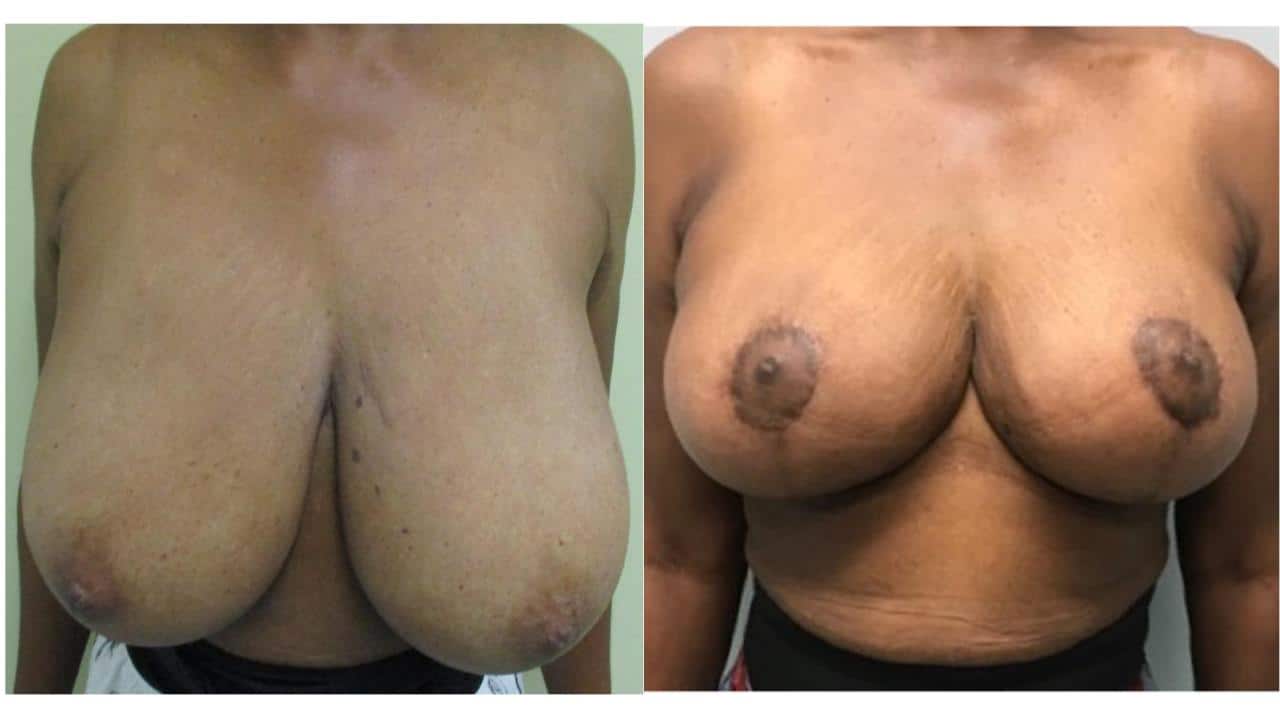 Breast Reduction.pptx 27