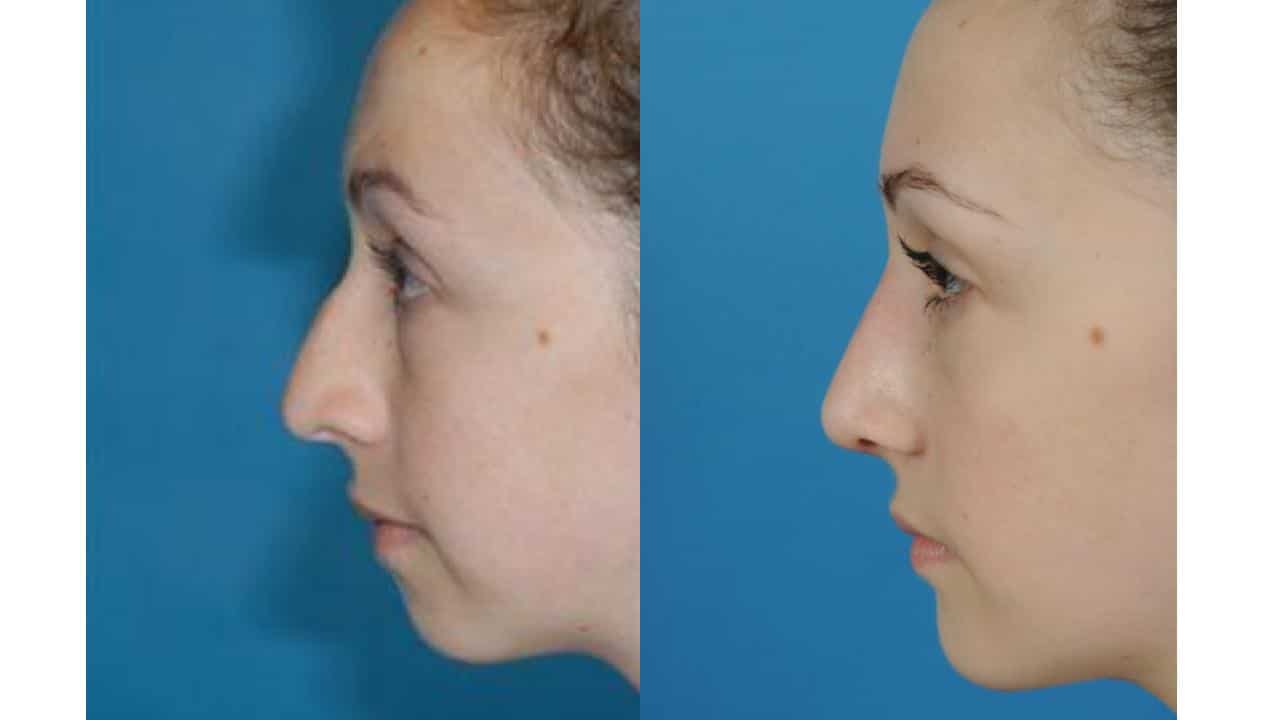 Genioplasty.pptx