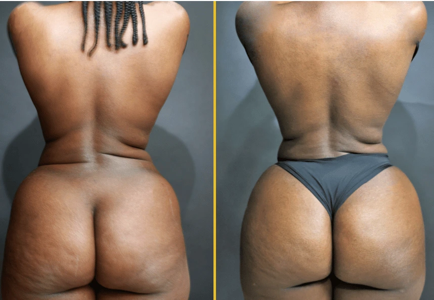 beforeafter BBLLipo 2
