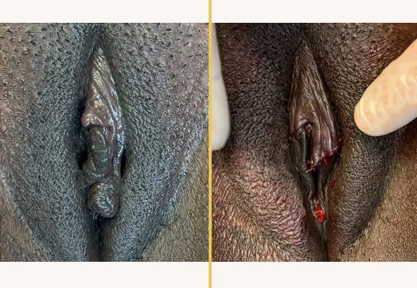 Case 0436