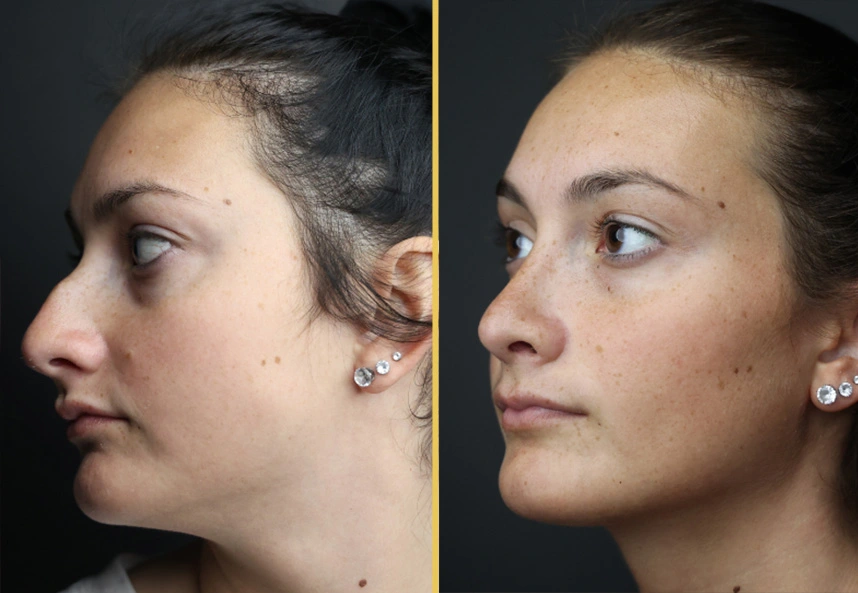 Before and after oblique view showing overall facial rejuvenation and contour enhancement