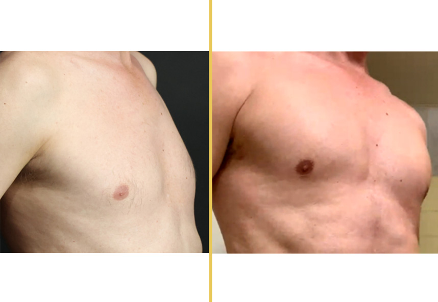 Before and after chest contouring from angled side view