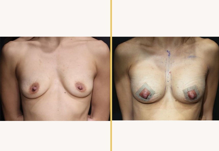 Before and after breast surgical case 633 showing front view comparison