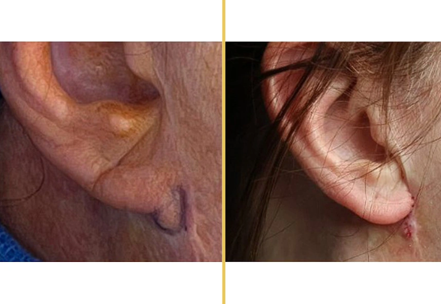 Before and after close-up of neck and ear area showing scar healing and neck improvement