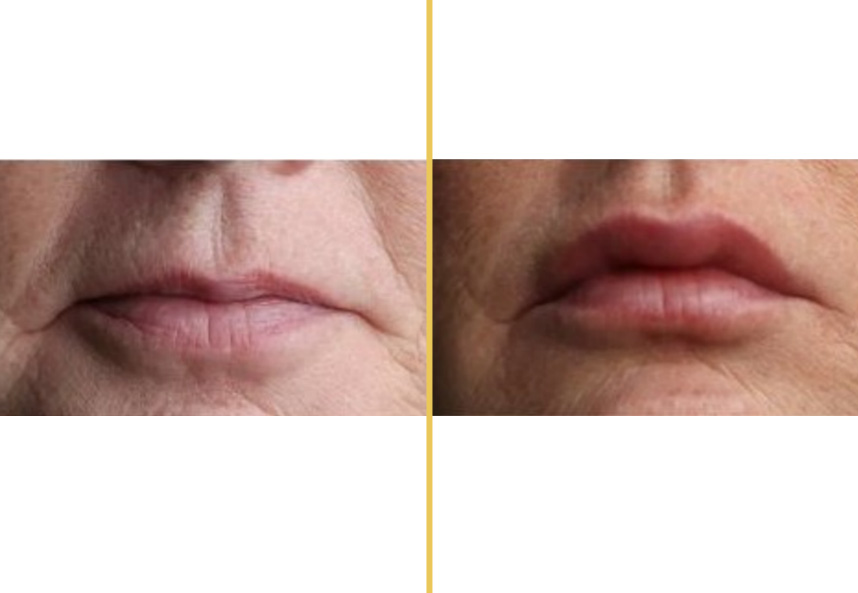 Before and after lip enhancement showing increased fullness