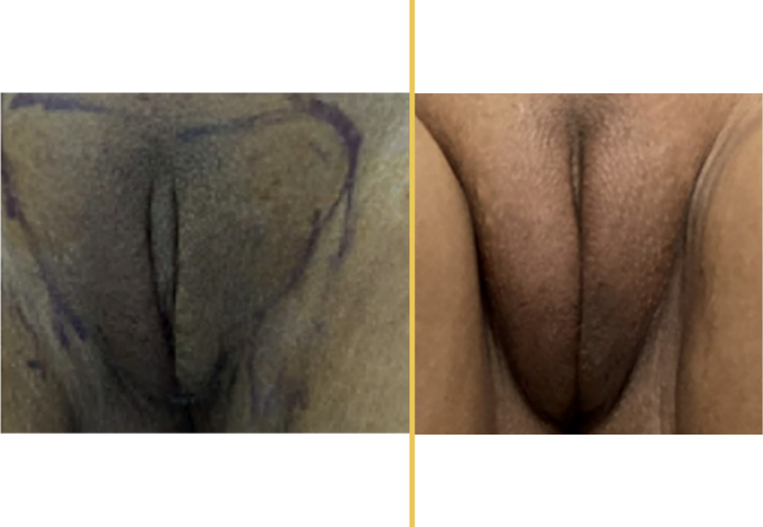 Before and after intimate surgery case 654 comparison