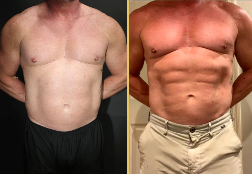 Before and after male patient showing front torso view with improved abdominal muscle definition