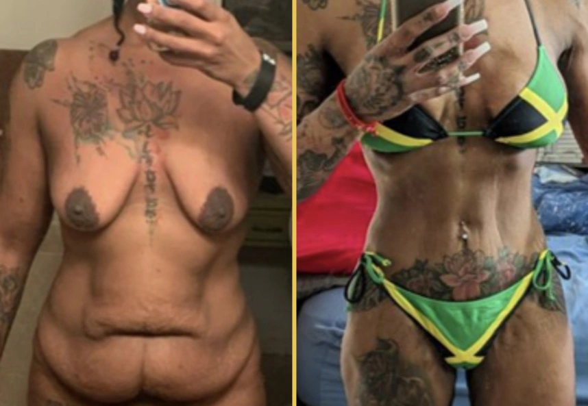 Before and after case 633: female torso showing before and after breast and body contouring results