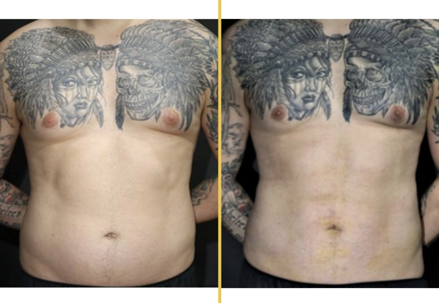 Before and after front view of tattooed male chest and abdomen showing improved body contour