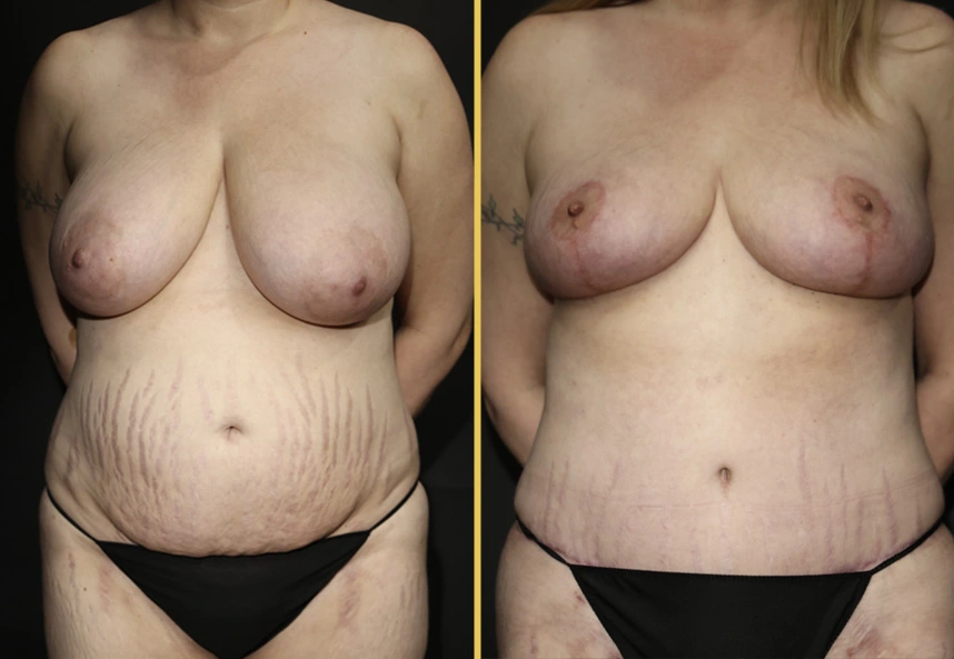 Before and after case 673A: female torso showing before and after breast and body contouring results
