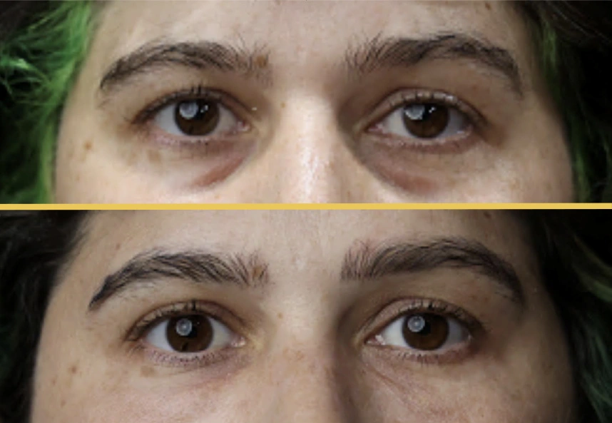 Before and after eye area showing reduced under-eye hollowing and improved contour