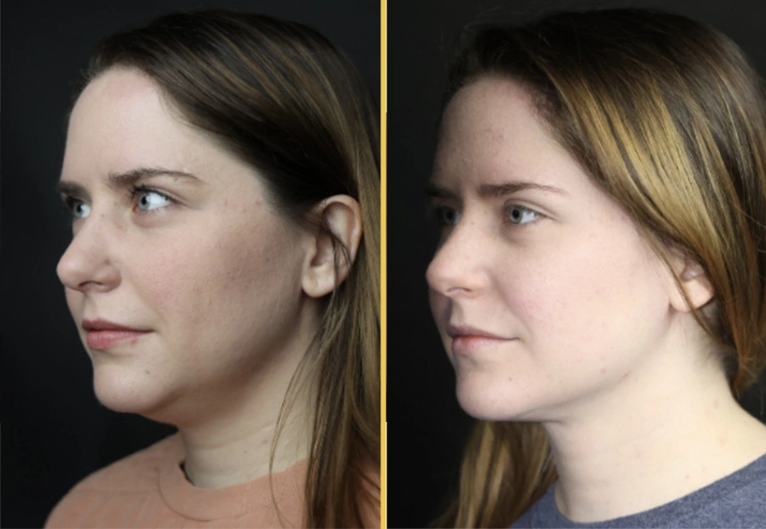 Before and after profile views showing refined nose shape and improved facial balance