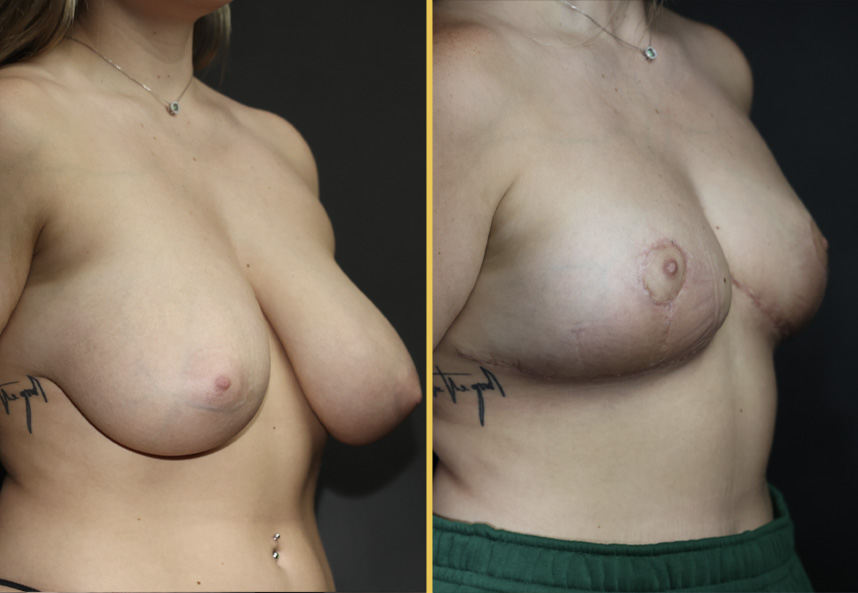 Before and after oblique views showing breast augmentation with improved volume and shape