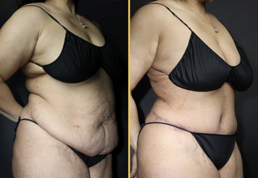 Before and after oblique view of tummy tuck results showing reduced abdominal skin and improved contour