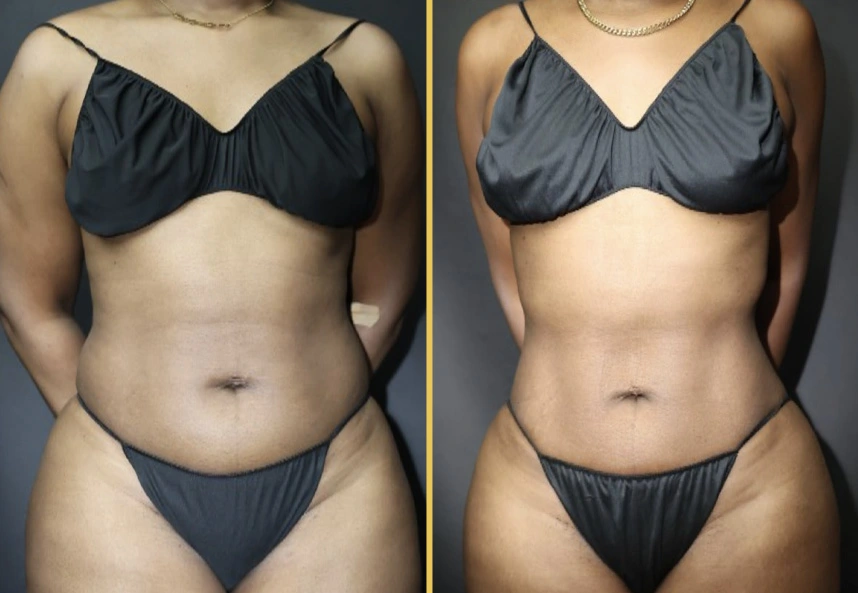 Before and after abdominal contouring, front view showing flattened abdomen