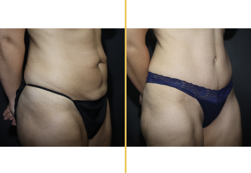 Before and after rear view of lower body showing body contouring results