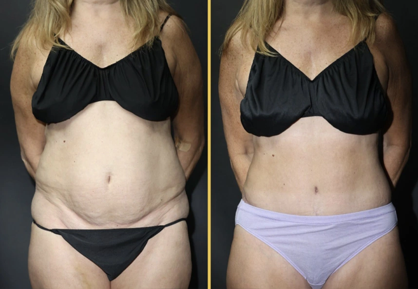 Before and after abdominal contouring, Case 706B