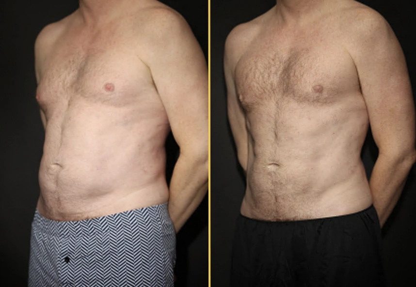 Before and after male torso showing abdominal contouring results