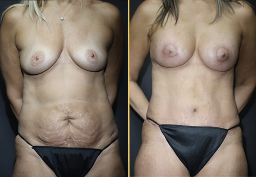 Before and after comparison of breast and abdominal contouring results