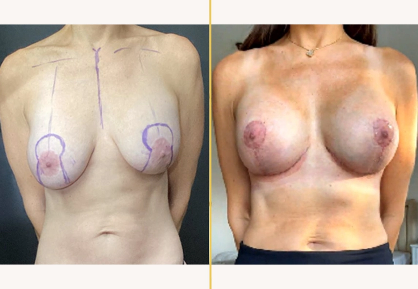 Before and after breast surgery case, with surgical markings and post-operative results
