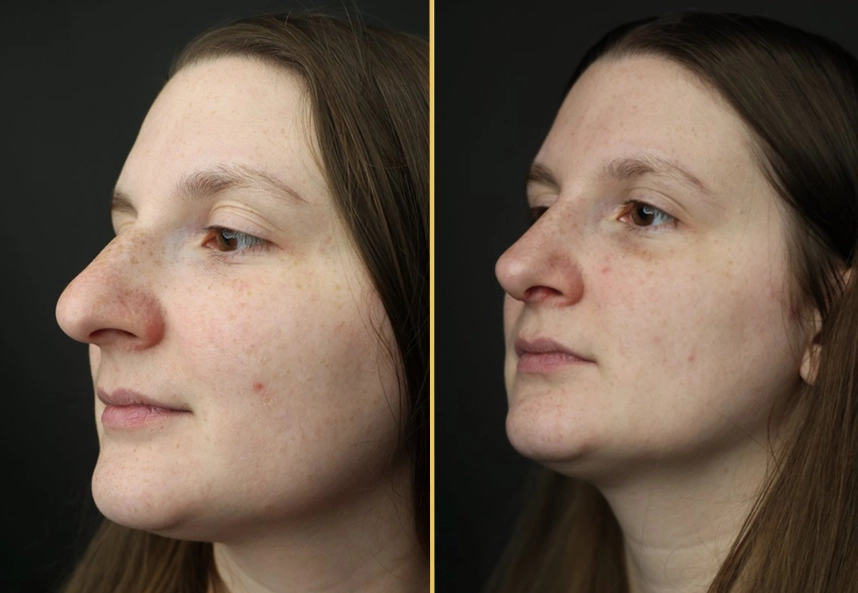 Before and after rhinoplasty case 717D, profile view