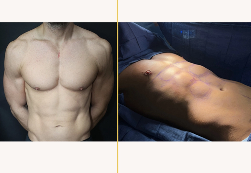 Before and after male torso showing abdominal definition and muscle tone