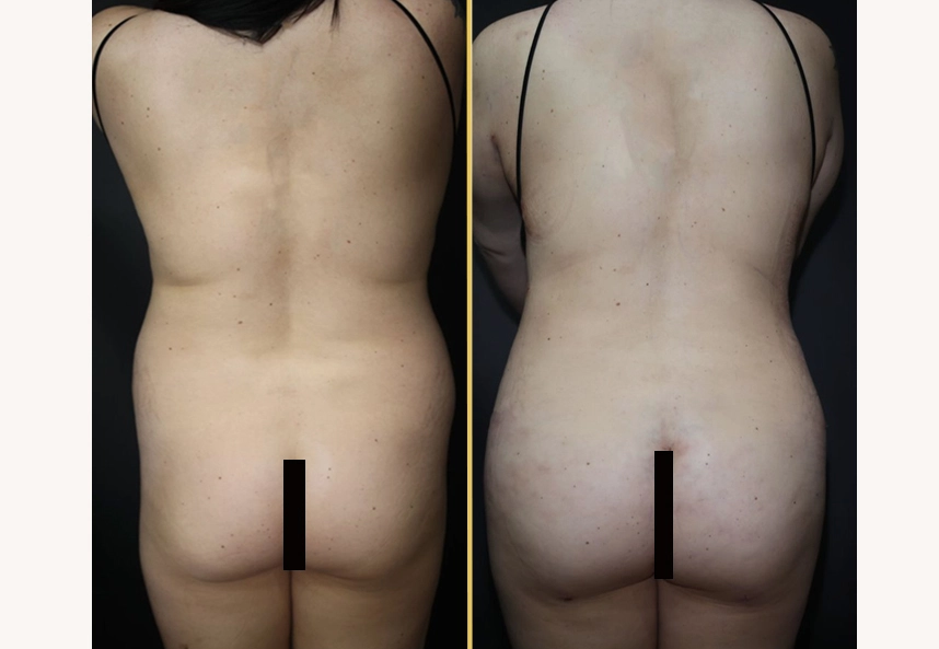 Before and after rear views showing buttock augmentation results