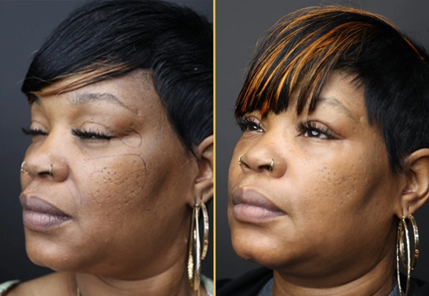 Before and after profile views of facial rejuvenation results showing improved skin texture and contour