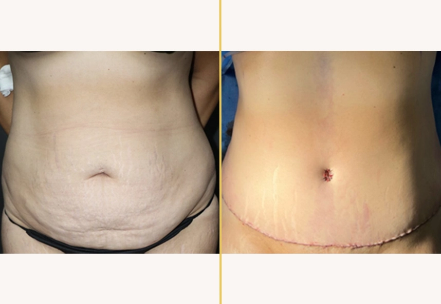 Before and after abdominal contouring, showing reduced midsection fullness and lower abdomen definition
