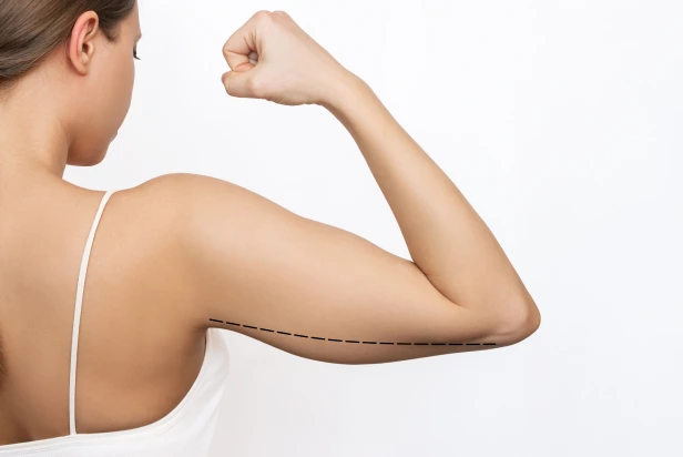 what is arm lift