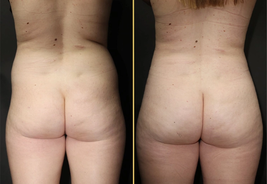 Before and after Brazilian butt lift results, rear view